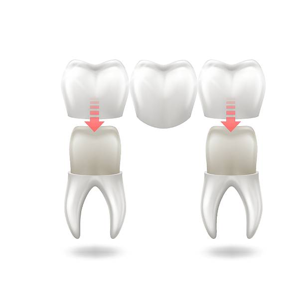istock Illustration of Dental Crown Procedure 2210772094