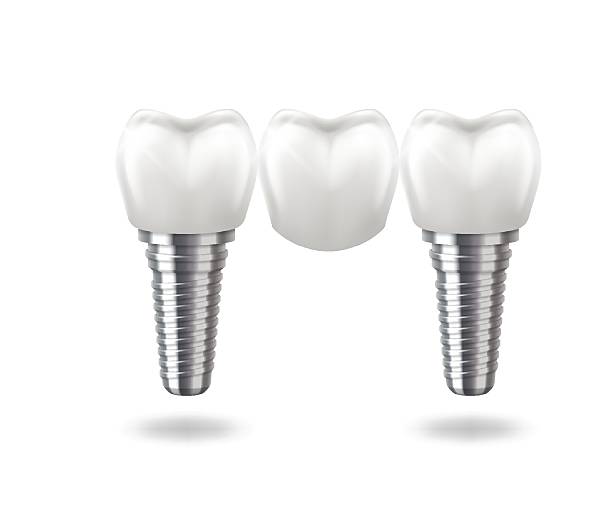 Realistic dental implants on white background Illustration of three dental implants in realistic style, metallic and white colors, representing oral care and dental procedures, on a white background with copy space. dental and vision care stock illustrations