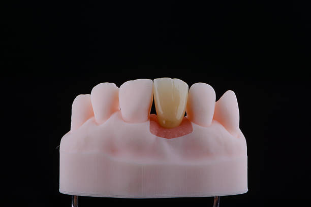 istock Mirror copy of central maxillary incisor, zirconia crown on titanium abutment fixed on printed model 2211036794