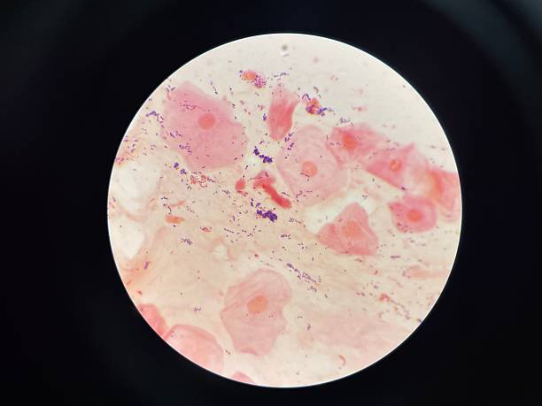 istock Mixed organism bacteria in sputum gram stain. 2211064888