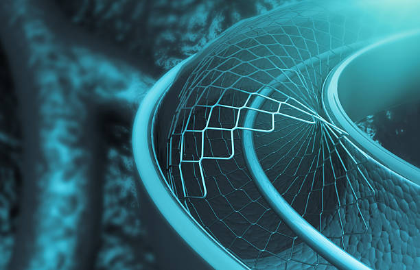 istock Stent implantation in artery for supporting blood circulation 2211393687
