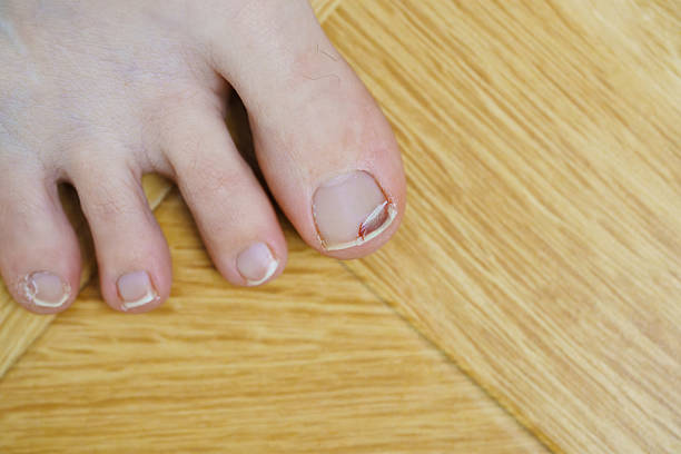 istock big toe with nail injury. 2211633314