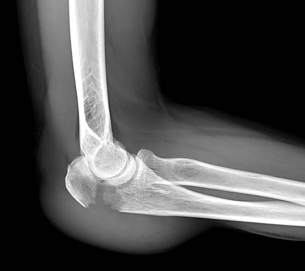 istock Before and After: Olecranon Fracture Treatment. 2211709042