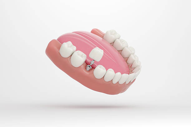 Lower Tooth Implant in Realistic Molar Area View