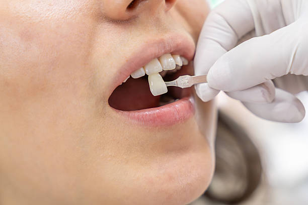 istock Dental Shade Matching in Cosmetic Dentistry 2211854127