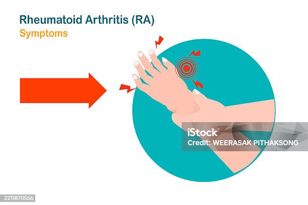 Arthritis Rife Rheumatoid Arthritis Stock Illustration - Download Image Now - Anatomy ...