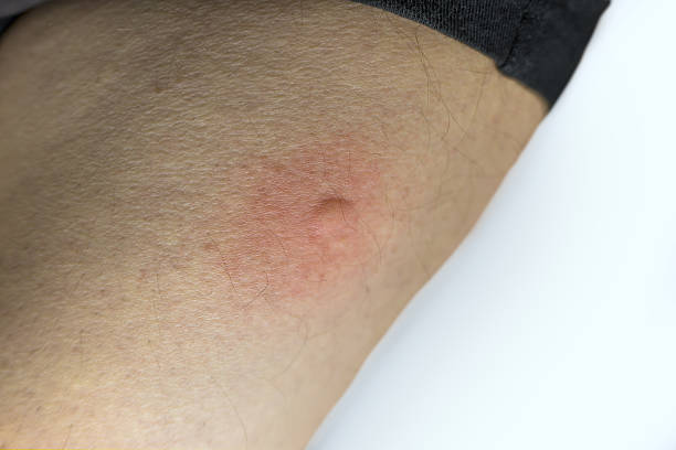 istock Insect bite on the human leg 2211963267