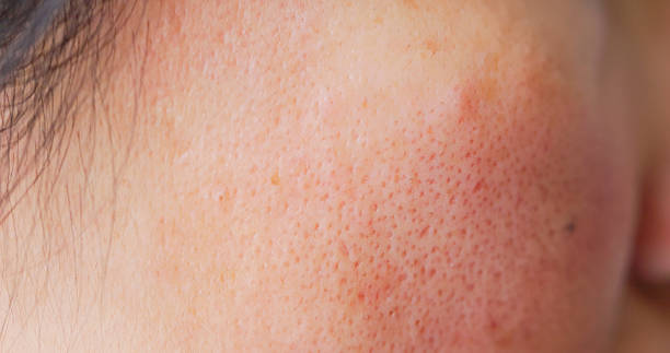 large pores skin