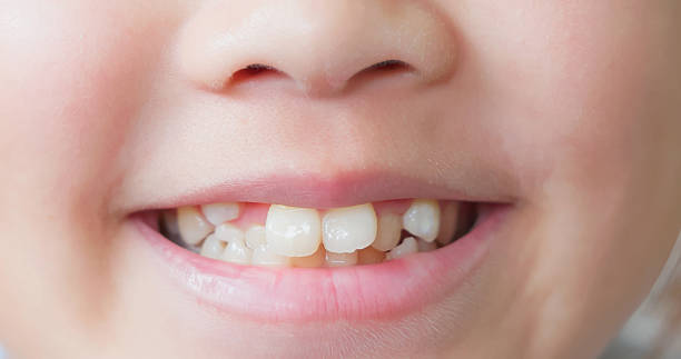 istock Child cavities and crooked teeth 2212091785