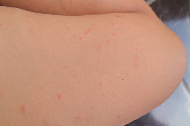 istock Irritated Skin with Multiple Mosquito Bites 2212239288