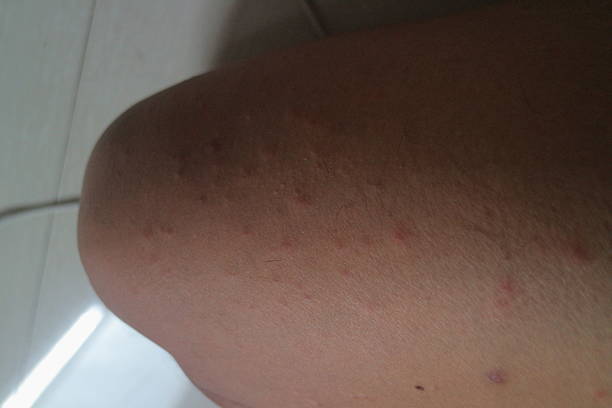 istock Common Skin Reaction to Mosquito Bites 2212243215