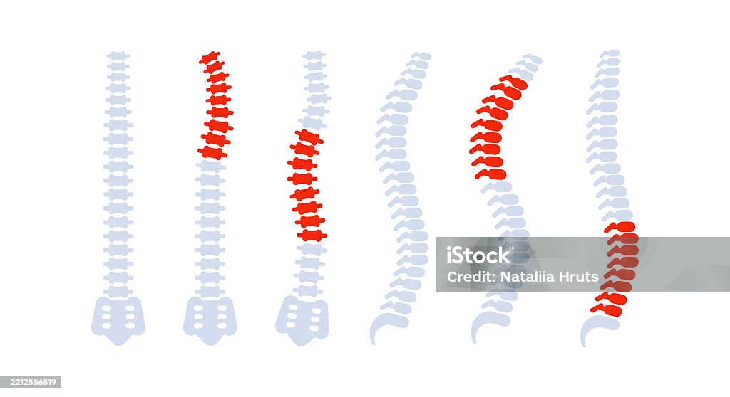 Human Spine Showing Different Problems And Pathologies Stock ...