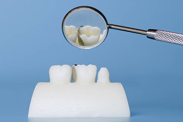 istock Dental sectional matrix contour system installation 2212678859
