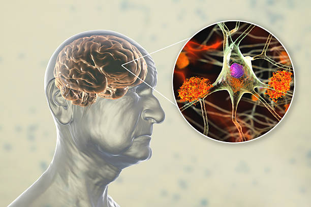 istock An elderly person with dementia, artwork 2212890269