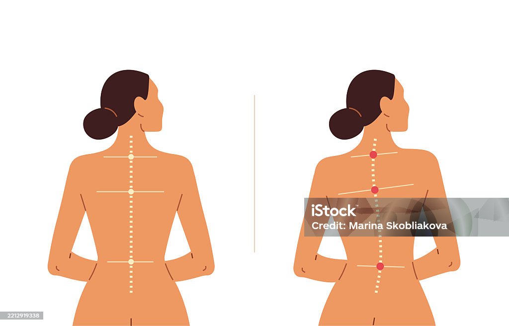 Posture Model From Rear Female Posture Comparison Correct Vs Poor Back Alignment Stock ...