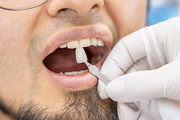 istock Dental Shade Matching in Cosmetic Dentistry 2212970409