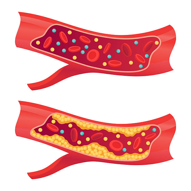 Types of cholesterol in human blood vessels. Normal and narrowed artery for explanation diseases. High-Density Lipoprotein HDL and Low-Density Lipoprotein LDL. Vector illustration Types of cholesterol in human blood vessels. Normal and narrowed artery for explanation diseases. High-Density Lipoprotein HDL and Low-Density Lipoprotein LDL . Vector illustration. hdl cholesterol stock illustrations
