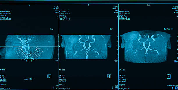 istock MRI Scan Human Cerebrovascular 2213496611