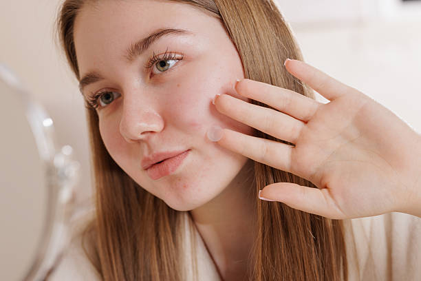 istock Young woman using acne patch on face, closeup skincare routine for blemish treatment. 2213662983