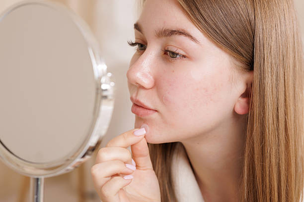 istock Girl uses transparent acne patch on chin and cheeks while checking skin in mirror. 2213663002