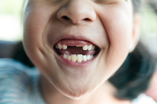 istock Close-Up of Child’s Mouth with Missing Front Tooth 2213929813