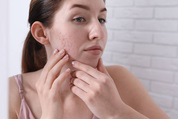 istock Woman with acne problem near mirror indoors 2214619495