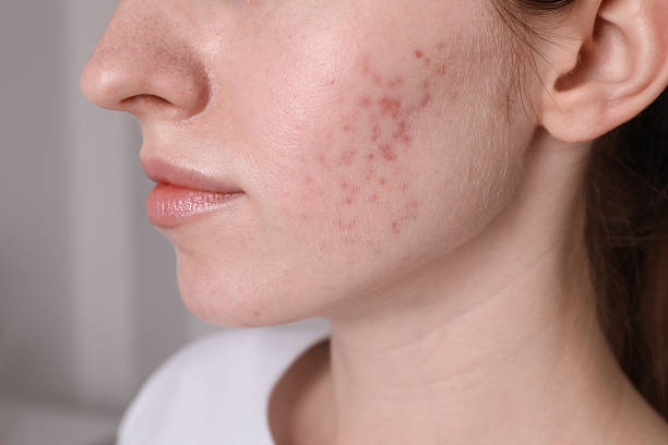 istock Woman with acne problem at home, closeup 2214619524