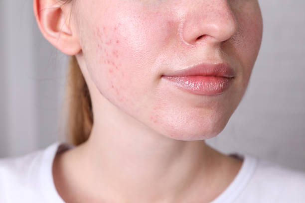 istock Woman with acne problem at home, closeup 2214619568
