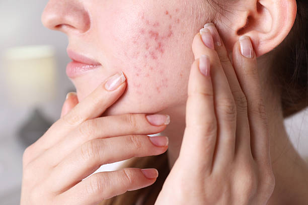 istock Woman with acne problem at home, closeup 2214619585