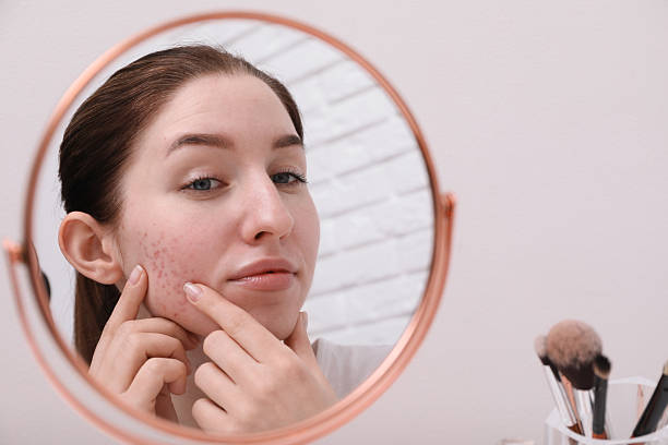 istock Woman with acne problem looking at mirror indoors 2214619618