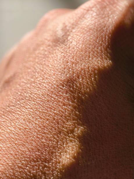 sunburn skin  on the back of a man