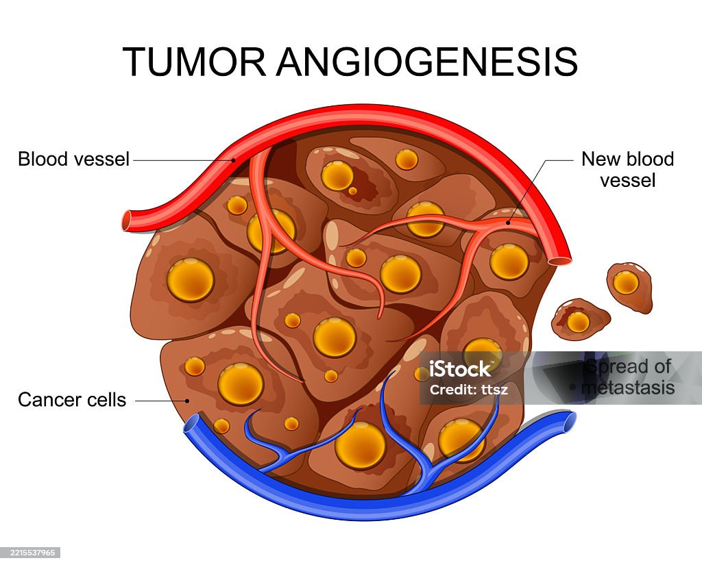Angiogenesis Simple Tumor Angiogenesis Cancer Cell Development And Metastasis Stock ...