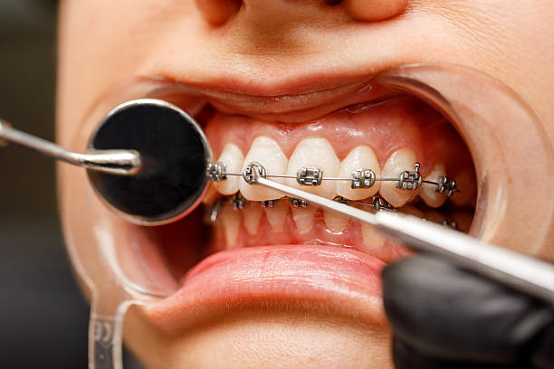istock Orthodontist examining braces with dental tools 2215658532