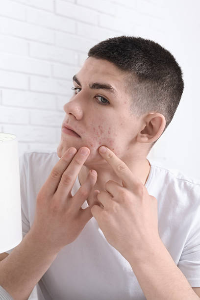 istock Upset young man looking at mirror and touching pimple on his face indoors. Acne problem 2215995750