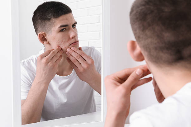 istock Upset young man looking at mirror and touching pimple on his face indoors. Acne problem 2215995751