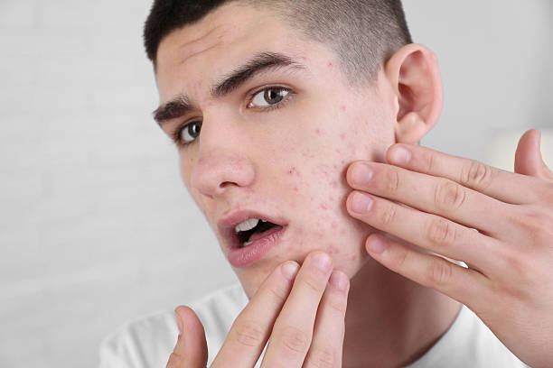 istock Upset young man touching pimple on his face indoors. Acne problem 2215995755