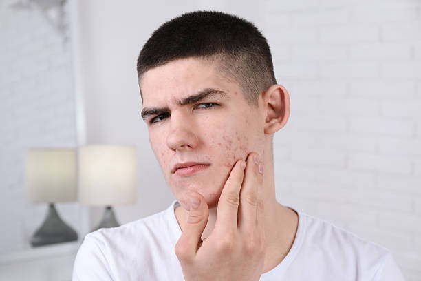 istock Young man touching pimple on his face indoors. Acne problem 2215995756