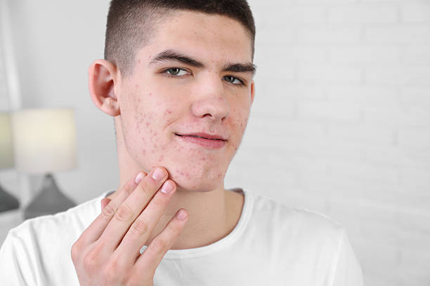 istock Young man touching pimple on his face indoors. Acne problem 2215995757