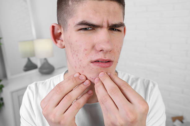 istock Upset young man touching pimple on his face indoors. Acne problem 2215995765