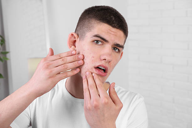 istock Upset young man touching pimple on his face indoors. Acne problem 2215995795