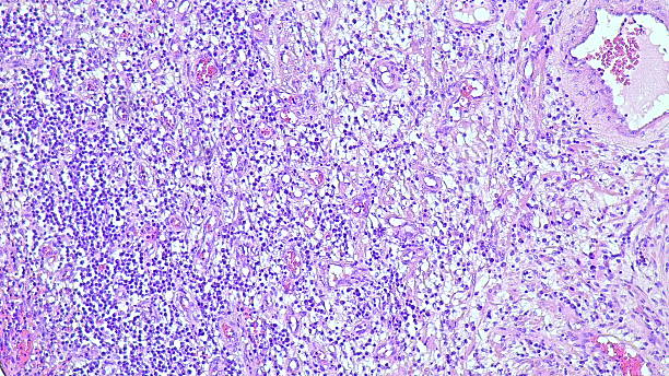 istock Photomicrograph showing histological features of benign prostatic hyperplasia in the anatomical pathology laboratory 2216000836