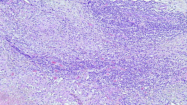 istock Caecum lymph node biopsy: Chronic nonspecific lymphadenitis. Photomicrograph show lymph node in pathology laboratory. 2216000846