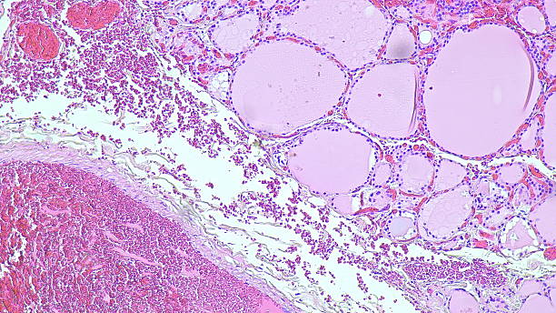 istock Micrograph showing histology of thyroid nodules under microscope with adenomatous goiter results in pathology laboratory. 2216000853
