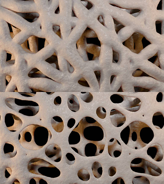 istock 3d Illustration of Osteoporosis 2216047549