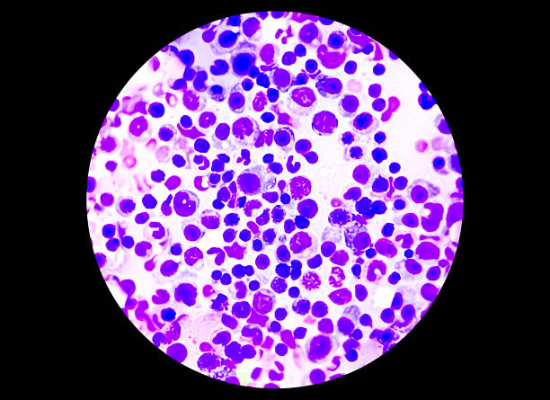 istock Chronic Myelogenous Leukemia (CML) cells in the blood smear analysed by microscope. 2216104175