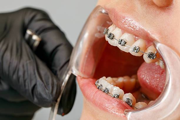 istock Side view of orthodontic treatment with braces and tools 2216200952