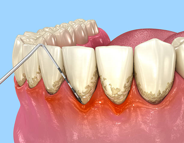 istock Gum recession test. Dental3D illustration 2216241917