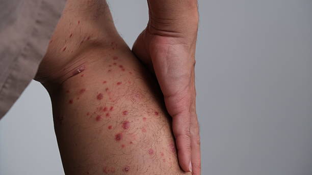 istock The early signs Psoriasis. 2216254351