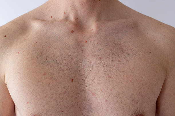istock Unrecognizable man with skin disease 2216319456