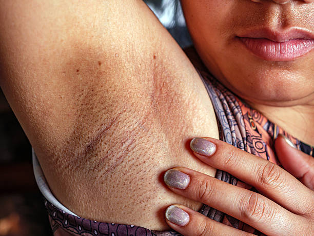 istock Close-up of Women armpit with problem black armpit. Dark and wrinkle armpit from deodorant allergic. 2216479479